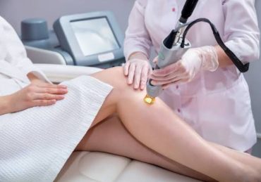 Laser varices